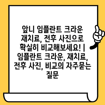 앞니 임플란트 크라운 재치료, 전후 사진으로 확실히 비교해보세요! | 임플란트 크라운, 재치료, 전후 사진, 비교