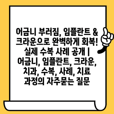 어금니 부러짐, 임플란트 & 크라운으로 완벽하게 회복! 실제 수복 사례 공개 | 어금니, 임플란트, 크라운, 치과, 수복, 사례, 치료 과정